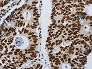 The image on the left is immunohistochemistry of paraffin-embedded Human colon cancer tissue using CSB-PA216935(SLC16A14 Antibody) at dilution 1/80, on the right is treated with synthetic peptide. (Original magnification: ×200)