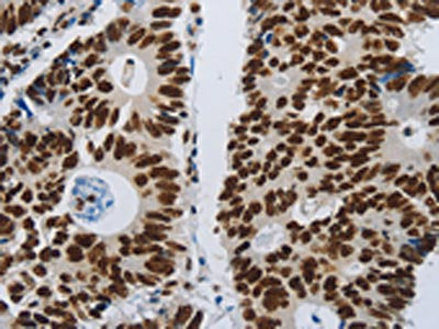 The image on the left is immunohistochemistry of paraffin-embedded Human colon cancer tissue using CSB-PA216935(SLC16A14 Antibody) at dilution 1/80, on the right is treated with synthetic peptide. (Original magnification: ×200)