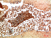 Immunohistochemical analysis of paraffin-embedded Human Lung Carcinoma Tissue using JAK1 Rabbit pAb diluted at 1:200