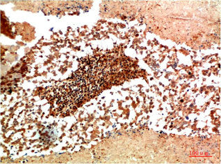Immunohistochemical analysis of paraffin-embedded Human Lung Carcinoma Tissue using JAK1 Rabbit pAb diluted at 1:200