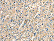 The image on the left is immunohistochemistry of paraffin-embedded Human liver cancer tissue using CSB-PA217397(PTGS2 Antibody) at dilution 1/40, on the right is treated with fusion protein. (Original magnification: ×200)