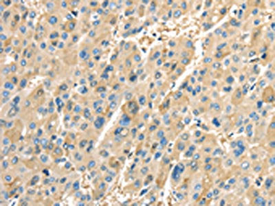 The image on the left is immunohistochemistry of paraffin-embedded Human liver cancer tissue using CSB-PA217397(PTGS2 Antibody) at dilution 1/40, on the right is treated with fusion protein. (Original magnification: ×200)