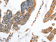 The image on the left is immunohistochemistry of paraffin-embedded Human colon cancer tissue using CSB-PA217516(AKR1D1 Antibody) at dilution 1/35, on the right is treated with fusion protein. (Original magnification: ×200)