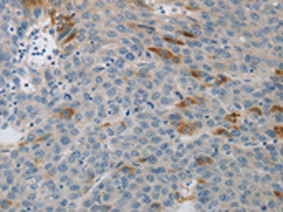 The image on the left is immunohistochemistry of paraffin-embedded Human liver cancer tissue using CSB-PA217530(MCMBP Antibody) at dilution 1/40, on the right is treated with synthetic peptide. (Original magnification: ×200)