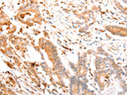 The image on the left is immunohistochemistry of paraffin-embedded Human colon cancer tissue using CSB-PA217707(ABCA4 Antibody) at dilution 1/30, on the right is treated with synthetic peptide. (Original magnification: ×200)