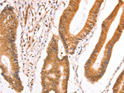 The image on the left is immunohistochemistry of paraffin-embedded Human colon cancer tissue using CSB-PA217735(TAX1BP1 Antibody) at dilution 1/40, on the right is treated with fusion protein. (Original magnification: ×200)