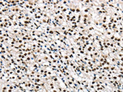 The image on the left is immunohistochemistry of paraffin-embedded Human prostate cancer tissue using CSB-PA217736(TALDO1 Antibody) at dilution 1/30, on the right is treated with fusion protein. (Original magnification: ×200)