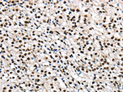 The image on the left is immunohistochemistry of paraffin-embedded Human prostate cancer tissue using CSB-PA217736(TALDO1 Antibody) at dilution 1/30, on the right is treated with fusion protein. (Original magnification: ×200)