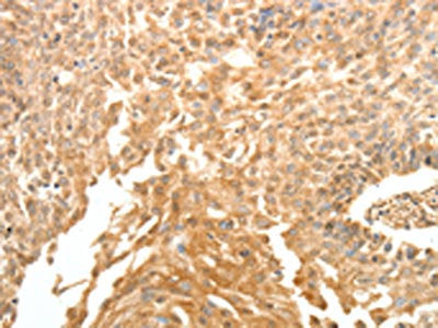 The image on the left is immunohistochemistry of paraffin-embedded Human cervical cancer tissue using CSB-PA217807(SYT6 Antibody) at dilution 1/30, on the right is treated with fusion protein. (Original magnification: ×200)