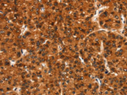 The image on the left is immunohistochemistry of paraffin-embedded Human liver cancer tissue using CSB-PA217827(BFAR Antibody) at dilution 1/20, on the right is treated with synthetic peptide. (Original magnification: ×200)