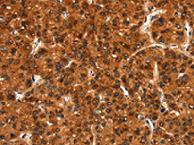 The image on the left is immunohistochemistry of paraffin-embedded Human liver cancer tissue using CSB-PA217827(BFAR Antibody) at dilution 1/20, on the right is treated with synthetic peptide. (Original magnification: ×200)