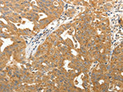 The image on the left is immunohistochemistry of paraffin-embedded Human ovarian cancer tissue using CSB-PA218026(MAP1B Antibody) at dilution 1/40, on the right is treated with synthetic peptide. (Original magnification: ×200)