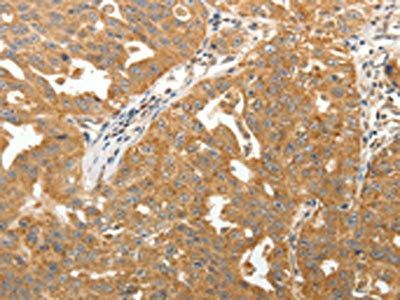 The image on the left is immunohistochemistry of paraffin-embedded Human ovarian cancer tissue using CSB-PA218026(MAP1B Antibody) at dilution 1/40, on the right is treated with synthetic peptide. (Original magnification: ×200)