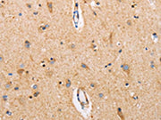 The image on the left is immunohistochemistry of paraffin-embedded Human brain tissue using CSB-PA218040(CTNNA1 Antibody) at dilution 1/15, on the right is treated with fusion protein. (Original magnification: ×200)