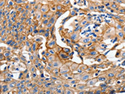 The image on the left is immunohistochemistry of paraffin-embedded Human cervical cancer tissue using CSB-PA218378(CDH1 Antibody) at dilution 1/100, on the right is treated with synthetic peptide. (Original magnification: X200)