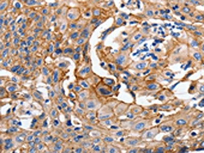 The image on the left is immunohistochemistry of paraffin-embedded Human cervical cancer tissue using CSB-PA218378(CDH1 Antibody) at dilution 1/100, on the right is treated with synthetic peptide. (Original magnification: X200)
