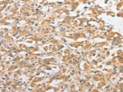 The image on the left is immunohistochemistry of paraffin-embedded Human thyroid cancer tissue using CSB-PA218621(TLR5 Antibody) at dilution 1/30, on the right is treated with fusion protein. (Original magnification: ×200)