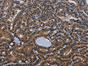 The image on the left is immunohistochemistry of paraffin-embedded Human thyroid cancer tissue using CSB-PA218625(INSIG2 Antibody) at dilution 1/30, on the right is treated with fusion protein. (Original magnification: ×200)