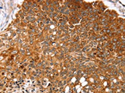 The image on the left is immunohistochemistry of paraffin-embedded Human esophagus cancer tissue using CSB-PA218758(MGST1 Antibody) at dilution 1/35, on the right is treated with synthetic peptide. (Original magnification: ×200)
