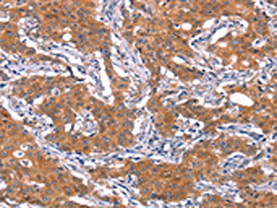 The image on the left is immunohistochemistry of paraffin-embedded Human gastic cancer tissue using CSB-PA218932(IRS1 Antibody) at dilution 1/30, on the right is treated with fusion protein. (Original magnification: ×200)