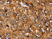 The image on the left is immunohistochemistry of paraffin-embedded Human liver cancer tissue using CSB-PA218953(SLC27A5 Antibody) at dilution 1/20, on the right is treated with synthetic peptide. (Original magnification: ×200)