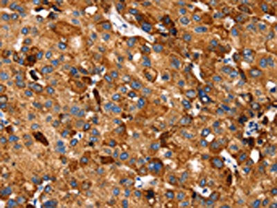 The image on the left is immunohistochemistry of paraffin-embedded Human liver cancer tissue using CSB-PA218953(SLC27A5 Antibody) at dilution 1/20, on the right is treated with synthetic peptide. (Original magnification: ×200)