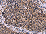 The image on the left is immunohistochemistry of paraffin-embedded Human ovarian cancer tissue using CSB-PA218975(CDC5L Antibody) at dilution 1/30, on the right is treated with fusion protein. (Original magnification: ×200)