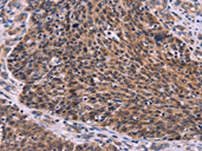 The image on the left is immunohistochemistry of paraffin-embedded Human ovarian cancer tissue using CSB-PA218975(CDC5L Antibody) at dilution 1/30, on the right is treated with fusion protein. (Original magnification: ×200)