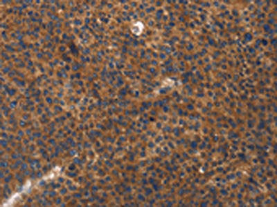 The image on the left is immunohistochemistry of paraffin-embedded Human liver cancer tissue using CSB-PA219130(ITGB3 Antibody) at dilution 1/20, on the right is treated with fusion protein. (Original magnification: ×200)