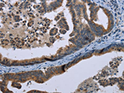 The image on the left is immunohistochemistry of paraffin-embedded Human gastic cancer tissue using CSB-PA219664(MARK4 Antibody) at dilution 1/20, on the right is treated with synthetic peptide. (Original magnification: ×200)