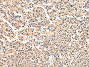 The image on the left is immunohistochemistry of paraffin-embedded Human liver cancer tissue using CSB-PA219820(VPS33B Antibody) at dilution 1/25, on the right is treated with fusion protein. (Original magnification: ×200)