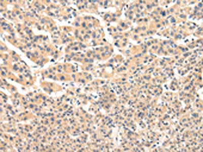 The image on the left is immunohistochemistry of paraffin-embedded Human liver cancer tissue using CSB-PA219820(VPS33B Antibody) at dilution 1/25, on the right is treated with fusion protein. (Original magnification: ×200)