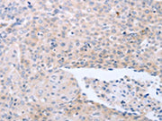 The image on the left is immunohistochemistry of paraffin-embedded Human ovarian cancer tissue using CSB-PA219834(NRTN Antibody) at dilution 1/40, on the right is treated with synthetic peptide. (Original magnification: ×200)
