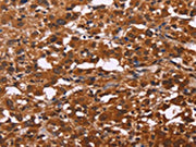 The image on the left is immunohistochemistry of paraffin-embedded Human thyroid cancer tissue using CSB-PA219850(ART5 Antibody) at dilution 1/50, on the right is treated with fusion protein. (Original magnification: ×200)