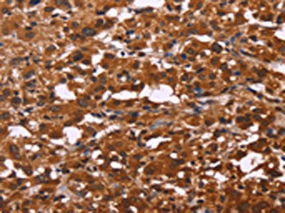 The image on the left is immunohistochemistry of paraffin-embedded Human thyroid cancer tissue using CSB-PA219850(ART5 Antibody) at dilution 1/50, on the right is treated with fusion protein. (Original magnification: ×200)