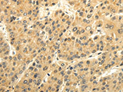 The image on the left is immunohistochemistry of paraffin-embedded Human liver cancer tissue using CSB-PA219867(GAD1 Antibody) at dilution 1/35, on the right is treated with synthetic peptide. (Original magnification: ×200)