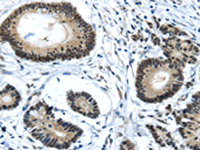 The image on the left is immunohistochemistry of paraffin-embedded Human colorectal cancer tissue using CSB-PA219965(MED4 Antibody) at dilution 1/25, on the right is treated with fusion protein. (Original magnification: ×200)