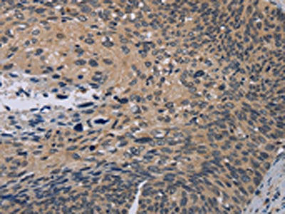 The image on the left is immunohistochemistry of paraffin-embedded Human cervical cancer tissue using CSB-PA220321(NOX1 Antibody) at dilution 1/50, on the right is treated with synthetic peptide. (Original magnification: ×200)