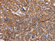 The image on the left is immunohistochemistry of paraffin-embedded Human thyroid cancer tissue using CSB-PA220820(NDUFA1 Antibody) at dilution 1/70, on the right is treated with fusion protein. (Original magnification: ×200)