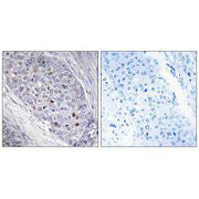 Immunohistochemistry analysis of paraffin-embedded human breast carcinoma tissue, using MEF2C antibody.