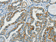 The image on the left is immunohistochemistry of paraffin-embedded Human thyroid cancer tissue using CSB-PA220876(NPAP1 Antibody) at dilution 1/70, on the right is treated with synthetic peptide. (Original magnification: ×200)