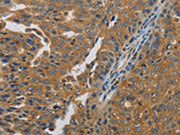 The image on the left is immunohistochemistry of paraffin-embedded Human ovarian cancer tissue using CSB-PA220976(MMP8 Antibody) at dilution 1/45, on the right is treated with synthetic peptide. (Original magnification: ×200)
