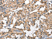 The image on the left is immunohistochemistry of paraffin-embedded Human thyroid cancer tissue using CSB-PA221214(HGF Antibody) at dilution 1/65, on the right is treated with fusion protein. (Original magnification: ×200)