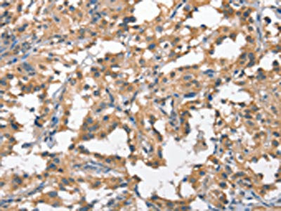 The image on the left is immunohistochemistry of paraffin-embedded Human thyroid cancer tissue using CSB-PA221214(HGF Antibody) at dilution 1/65, on the right is treated with fusion protein. (Original magnification: ×200)
