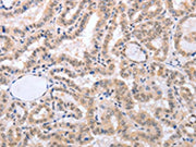 The image on the left is immunohistochemistry of paraffin-embedded Human thyroid cancer tissue using CSB-PA221364(FADD Antibody) at dilution 1/50, on the right is treated with fusion protein. (Original magnification: ×200)