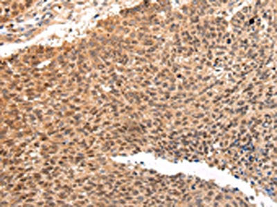 The image on the left is immunohistochemistry of paraffin-embedded Human lung cancer tissue using CSB-PA221484(ATF1 Antibody) at dilution 1/35, on the right is treated with synthetic peptide. (Original magnification: ×200)