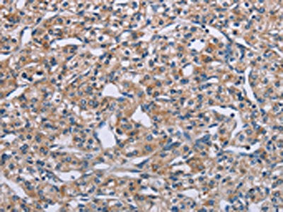 The image on the left is immunohistochemistry of paraffin-embedded Human prostate cancer tissue using CSB-PA221959(PLXNA2 Antibody) at dilution 1/40, on the right is treated with synthetic peptide. (Original magnification: ×200)