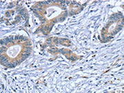 The image on the left is immunohistochemistry of paraffin-embedded Human colon cancer tissue using CSB-PA221978(SLITRK4 Antibody) at dilution 1/20, on the right is treated with fusion protein. (Original magnification: ×200)