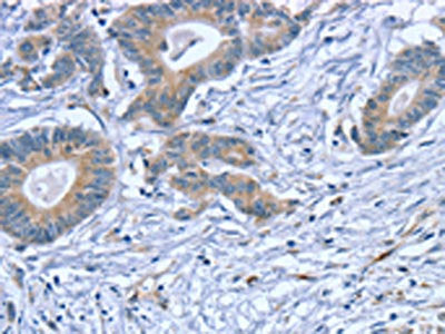 The image on the left is immunohistochemistry of paraffin-embedded Human colon cancer tissue using CSB-PA221978(SLITRK4 Antibody) at dilution 1/20, on the right is treated with fusion protein. (Original magnification: ×200)