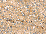 The image on the left is immunohistochemistry of paraffin-embedded Human liver cancer tissue using CSB-PA222058(EVA1A Antibody) at dilution 1/30, on the right is treated with synthetic peptide. (Original magnification: ×200)